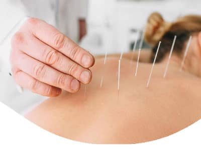 Acupuncture Therapy